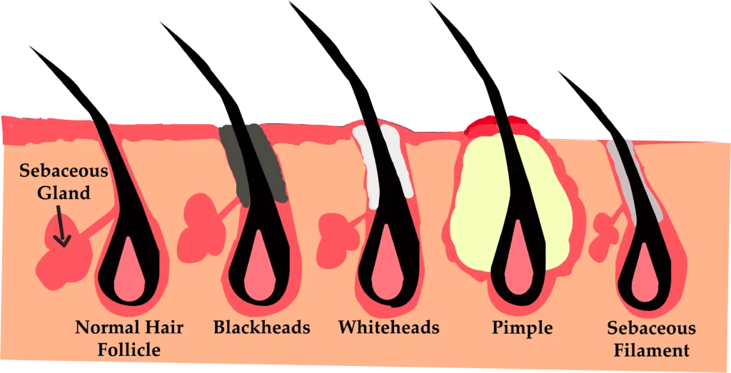 Explanation of Sebaceous Nose