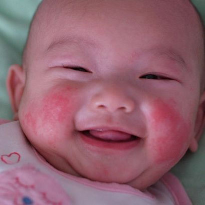 redness of cheeks of child