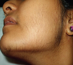 growth of hair on female cheeks 