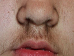 excessive hair growth above upper lips